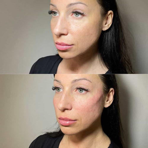 What Should You Know About the Botox Injection Process