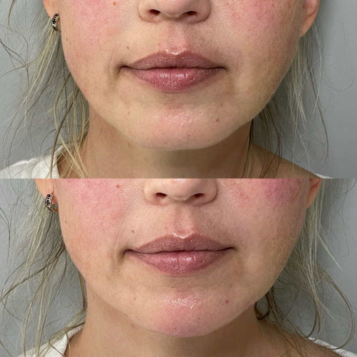 Can I get more fillers after 2 weeks?