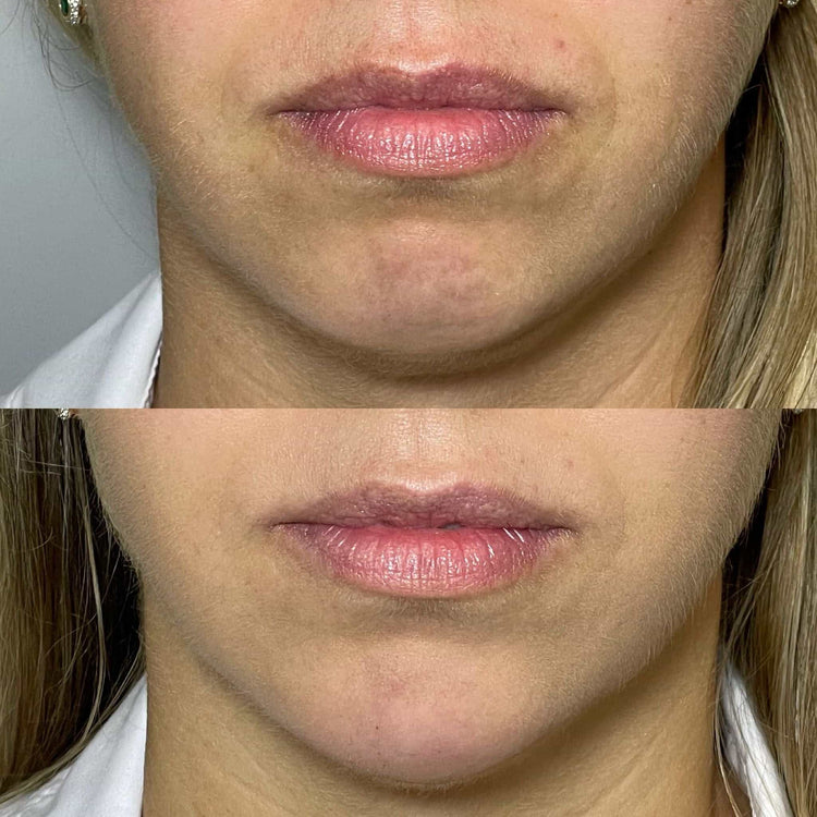 Non-Surgical Chin Enhancement in Warlingham, Surrey