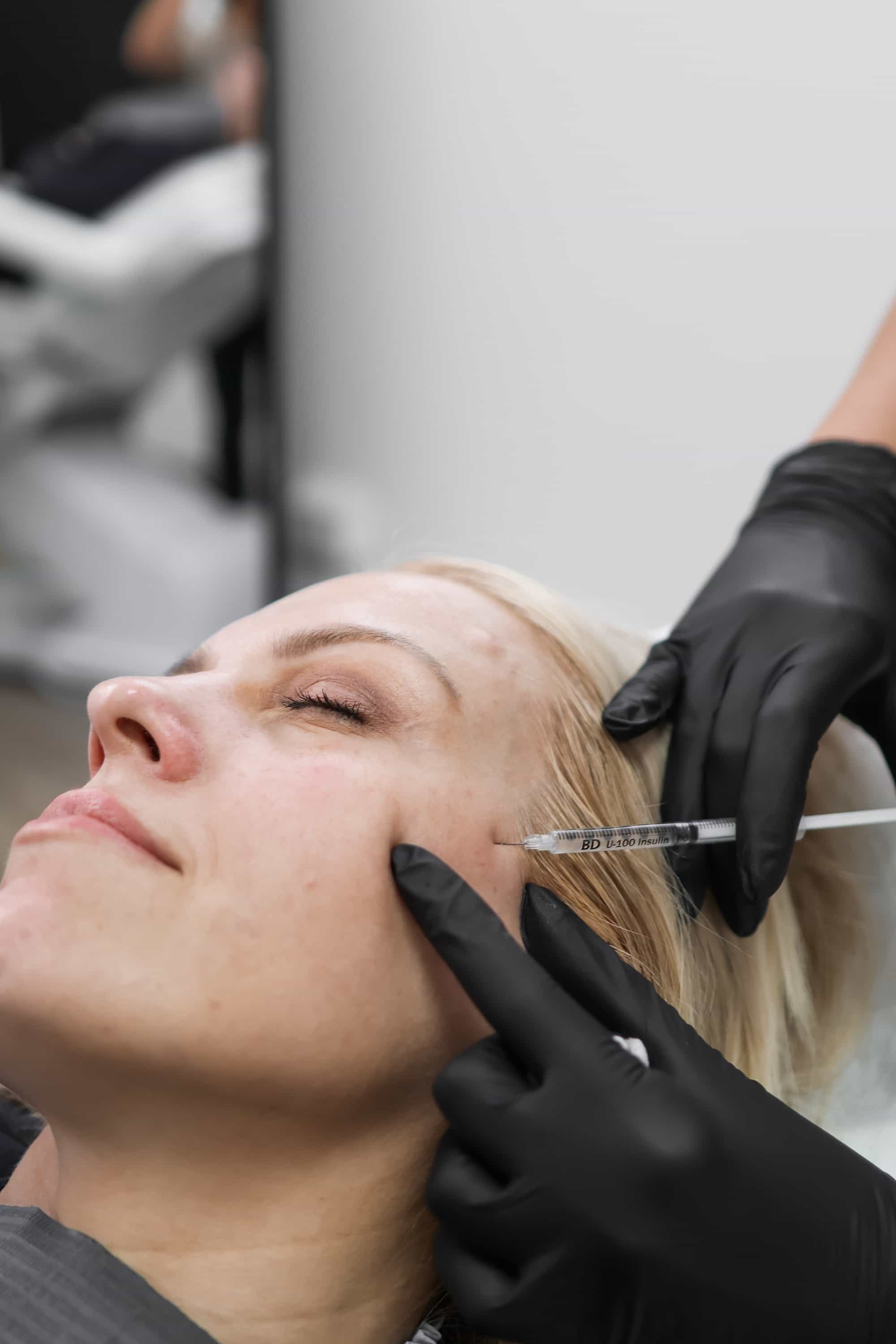 Sculptra for Skin Reconstruction in Surrey