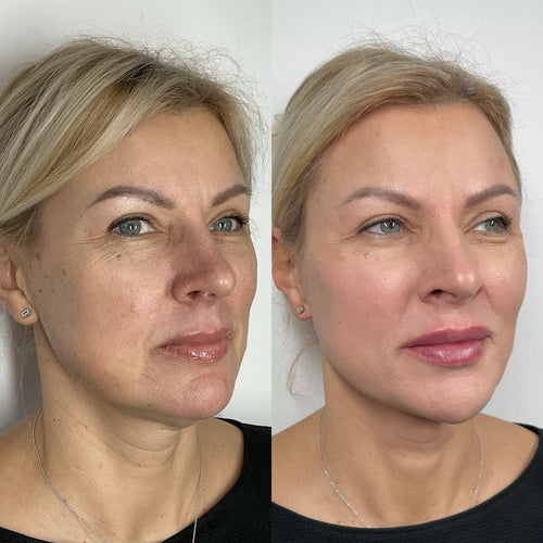 Why Cant You Smoke After Lip Filler