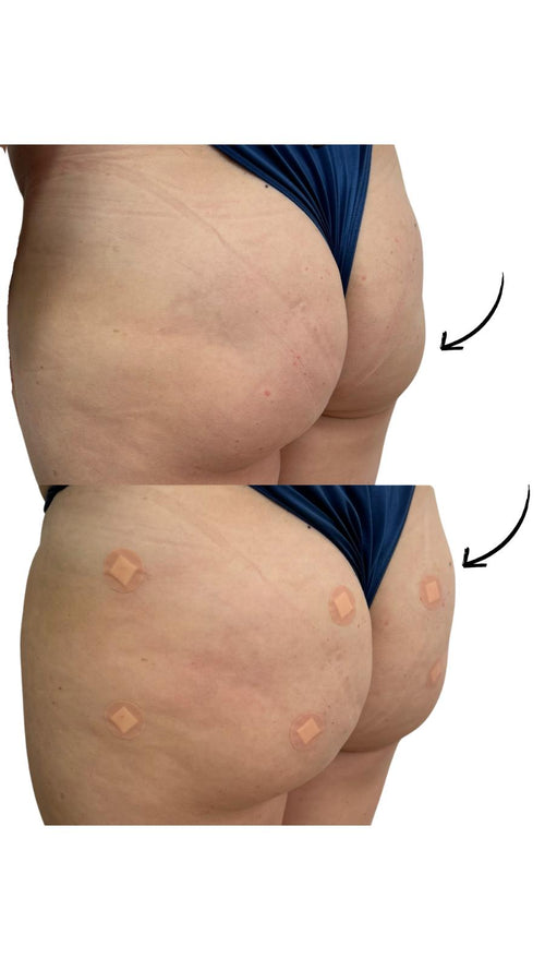 The Role of Collagen Boosting in Non-Surgical Brazilian Bum Lifts