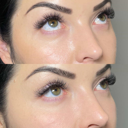 How long does Profhilo filler last?